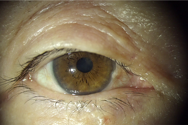 眼瞼下垂修正手術 術前