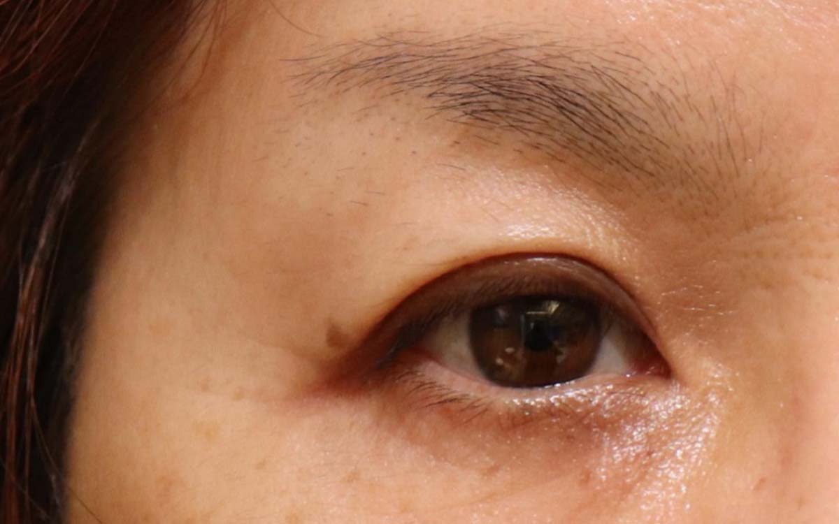 眼瞼下垂手術の症例 術前