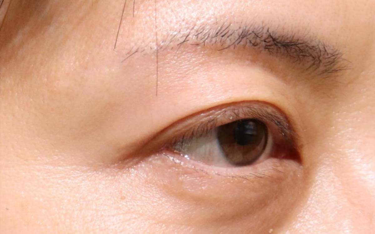 眼瞼下垂手術の症例 術後