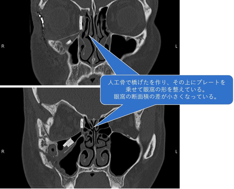 術後