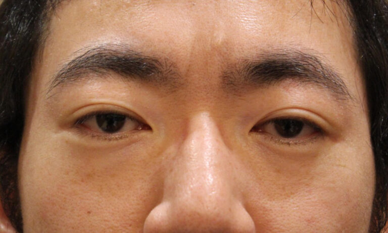 出目・はなれ目（眼球突出）　症例3 Before