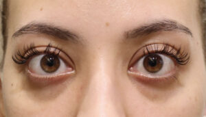 出目・はなれ目（眼球突出）　症例5 Before