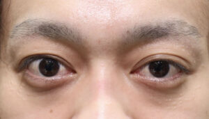 出目・はなれ目（眼球突出）　症例7 Before
