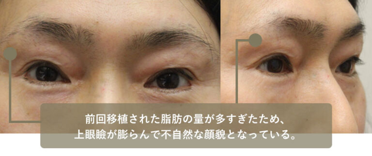 他院手術後修正 症例4 Before