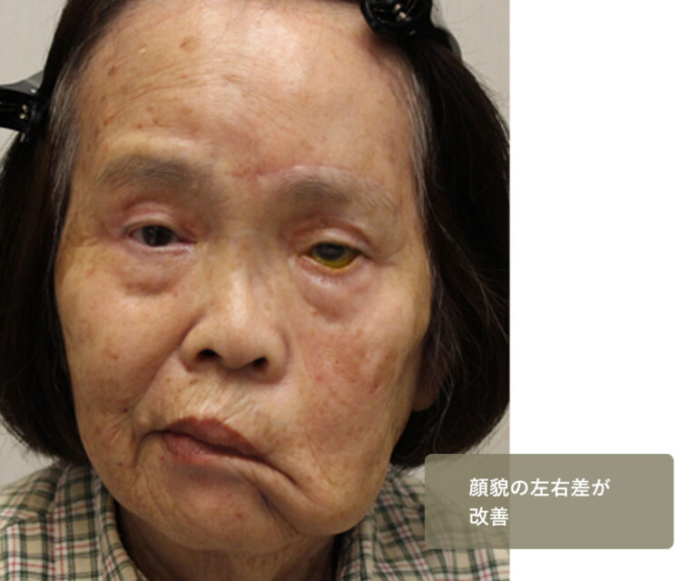 他院手術後修正 症例5 After