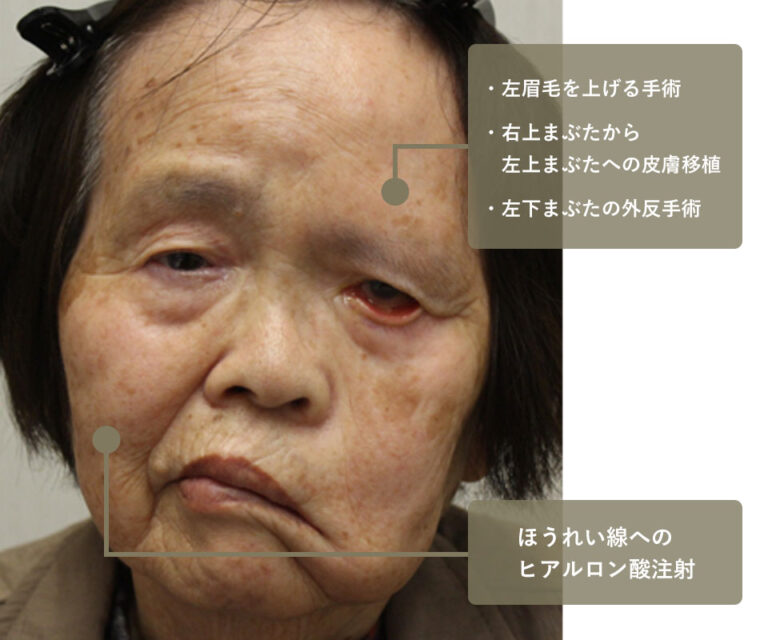 他院手術後修正 症例5 Before