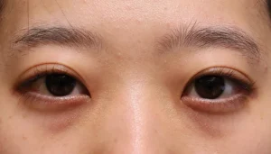 出目・はなれ目(眼球突出) 症例18 Before