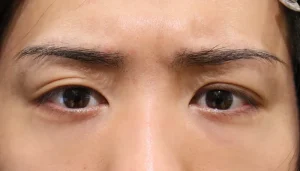 出目・はなれ目(眼球突出) 症例19 After