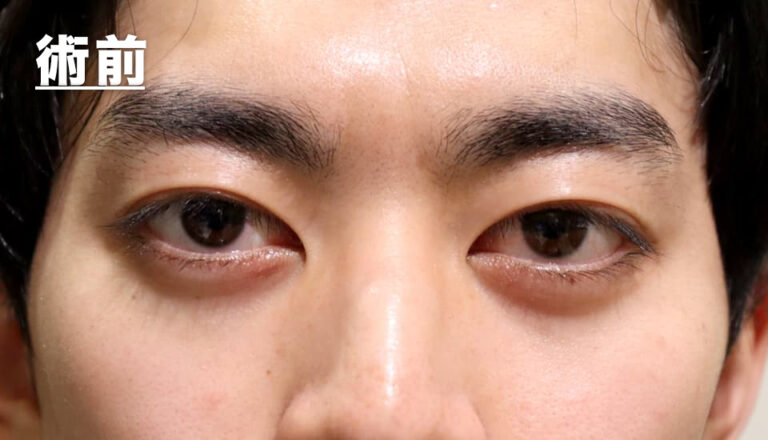 バセドウ病眼症・甲状腺眼症 症例7 Before