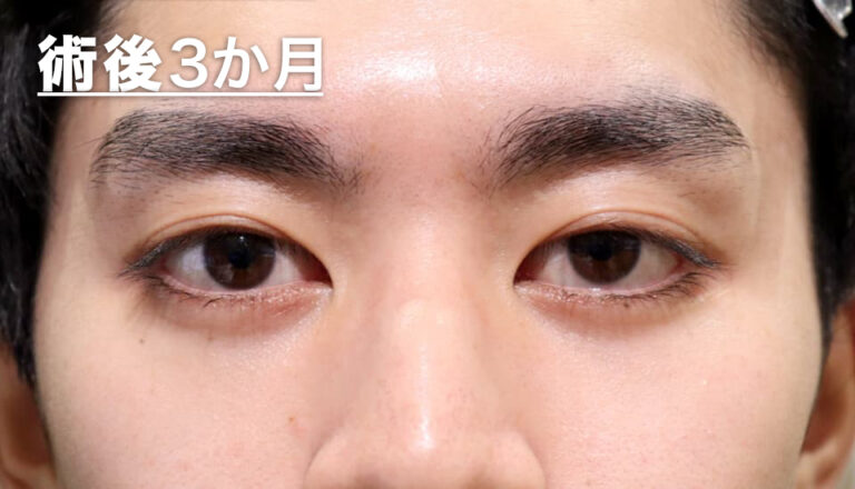 バセドウ病眼症・甲状腺眼症 症例7 After