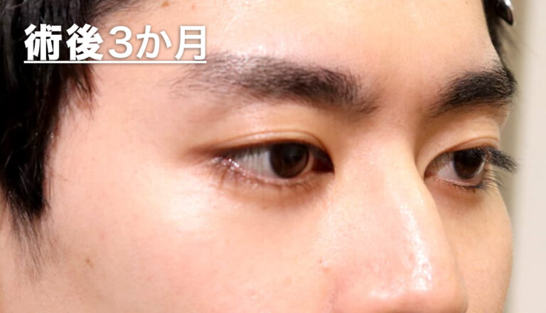 バセドウ病眼症・甲状腺眼症 症例7 After 2