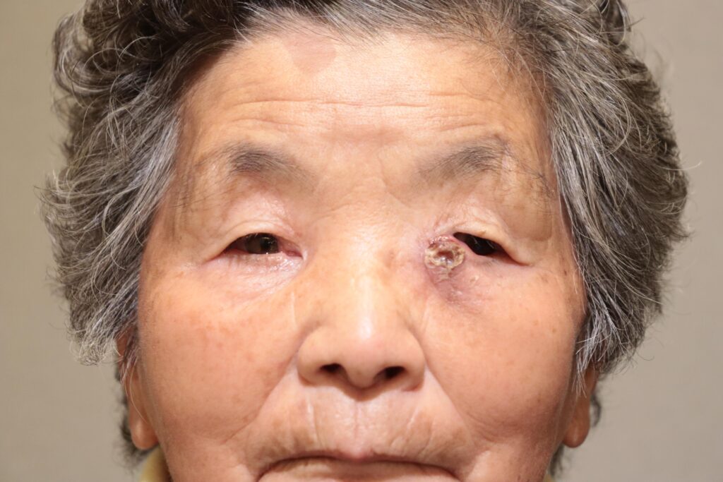 両側涙囊鼻腔吻合術(鼻内法) Before