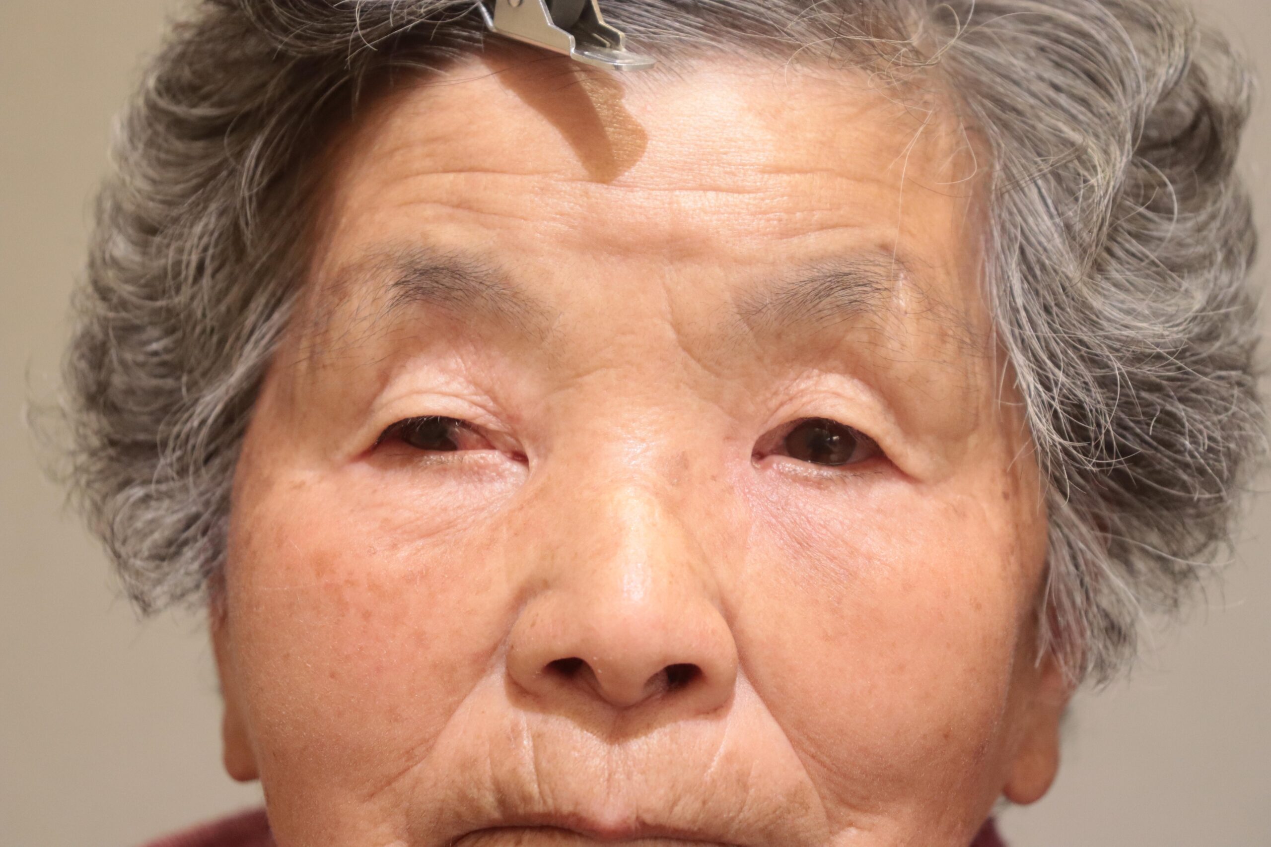 両側涙囊鼻腔吻合術(鼻内法) After